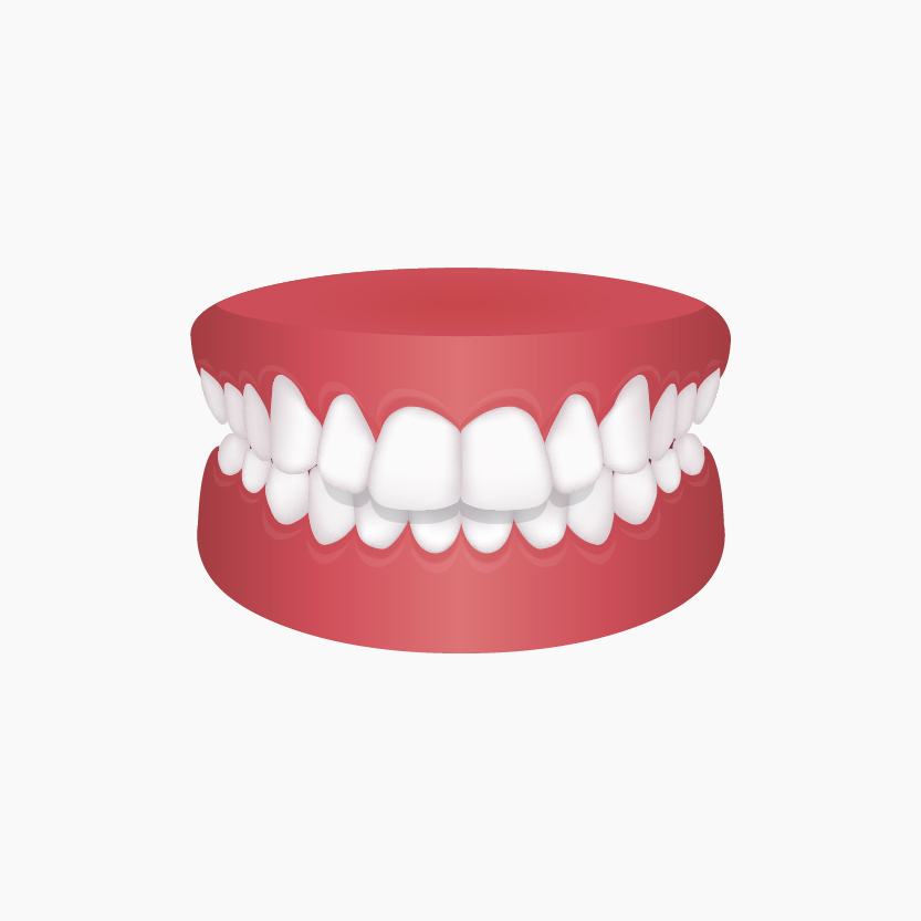 Fehlstllungten happy smile overbite