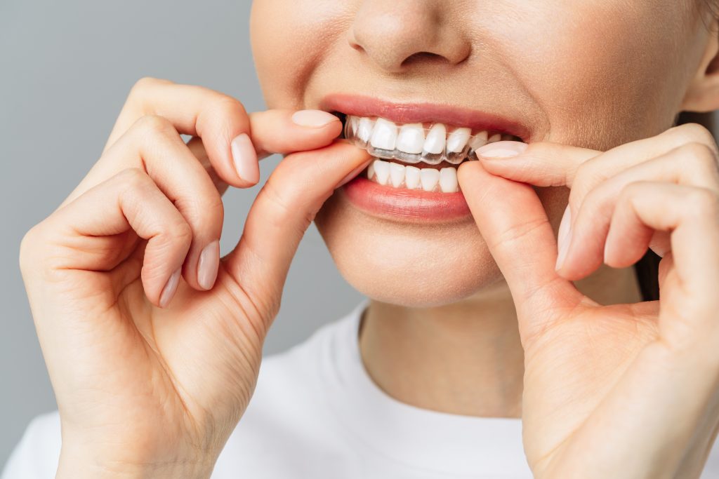 young woman does home teeth whitening procedure whitening tray with gel scaled