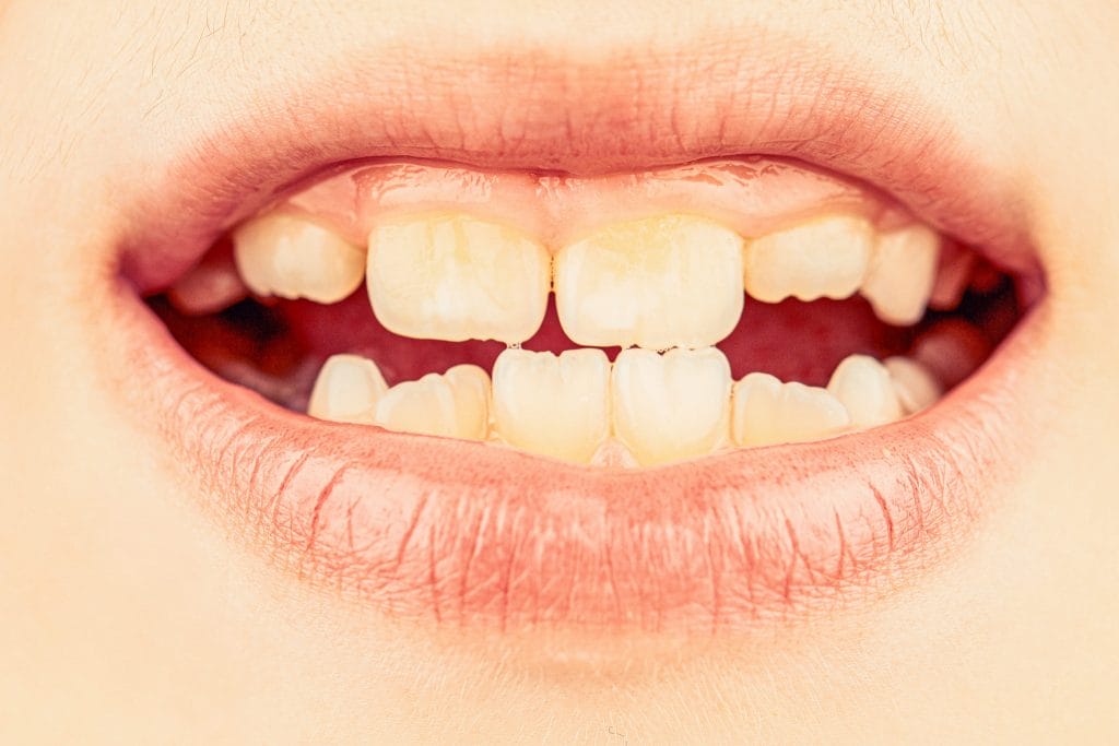 kid patient open mouth showing cavities teeth decay bad teeth child portrait boy with bad teeth close up unhealthy baby teeths
