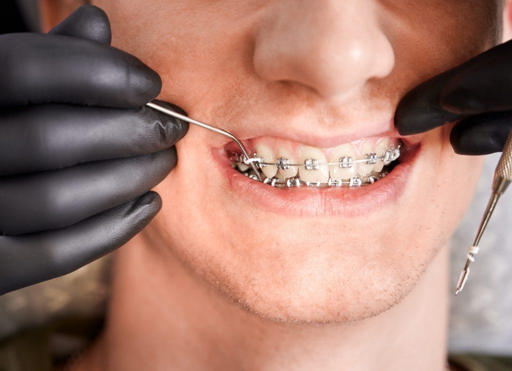 orthodontist placing rubber bands male patient braces